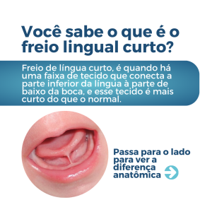 ✨ O que é o Freio de Língua Curto? É quando o pequeno pedaço de tecido abaixo da língua do bebê é mais curto do que o normal. Isso pode afetar a pega na mama e a sucção eficiente do leite materno. 😣 Quais os sintomas? Dor durante a amamentação. Má pega do bebê. Rachaduras nos mamilos. Ganho de peso insuficiente.